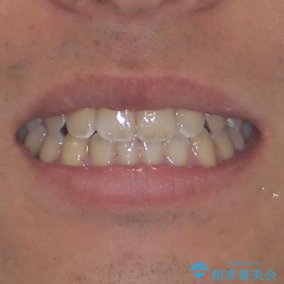 ワイヤー矯正を併用したインビザライン矯正治療の治療後(顔貌)