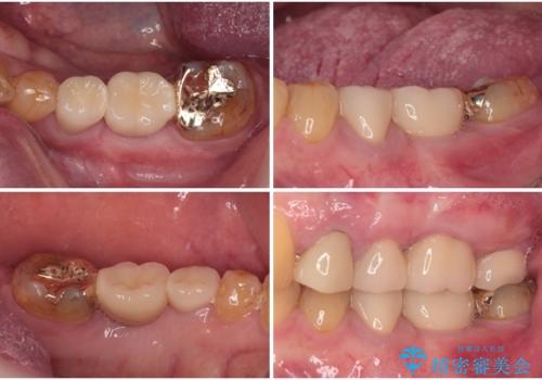 割れてしまった奥歯 インプラントによる補綴治療の治療後