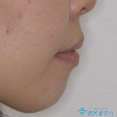 横顔の印象が大きく変わる ワイヤー装置での抜歯矯正の治療後(顔貌)