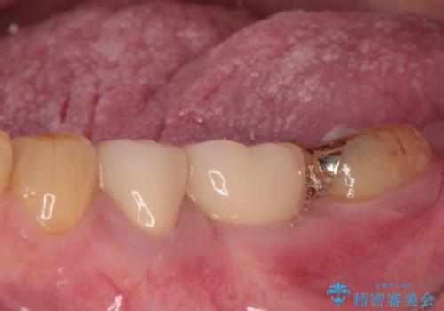 割れてしまった奥歯 インプラントによる補綴治療の治療後