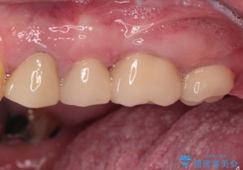 割れてしまった奥歯 インプラントによる補綴治療の治療後