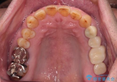 割れてしまった奥歯 インプラントによる補綴治療の治療後