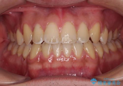 ワイヤー矯正を併用したインビザライン矯正治療の症例 治療後