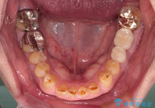 割れてしまった奥歯 インプラントによる補綴治療の治療後