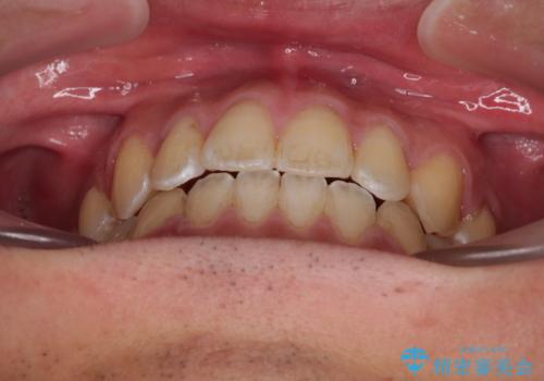 ワイヤー矯正を併用したインビザライン矯正治療の治療後