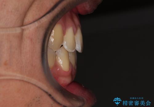 ワイヤー矯正を併用したインビザライン矯正治療の治療後