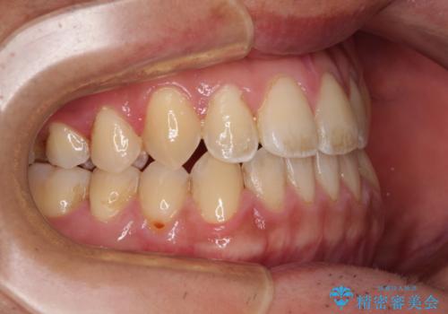 ワイヤー矯正を併用したインビザライン矯正治療の治療後