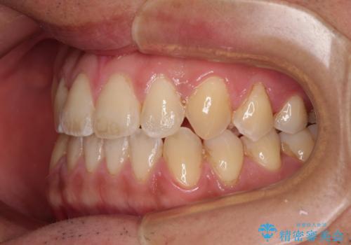 ワイヤー矯正を併用したインビザライン矯正治療の治療後