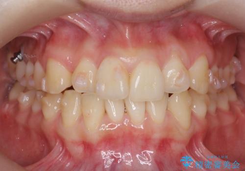 前歯がねじれている 奥歯を後ろに下げて歯を抜かずに並べましたの治療中