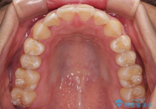 ワイヤー矯正を併用したインビザライン矯正治療の治療後