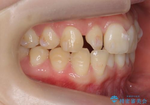 前歯がねじれている 奥歯を後ろに下げて歯を抜かずに並べましたの治療中