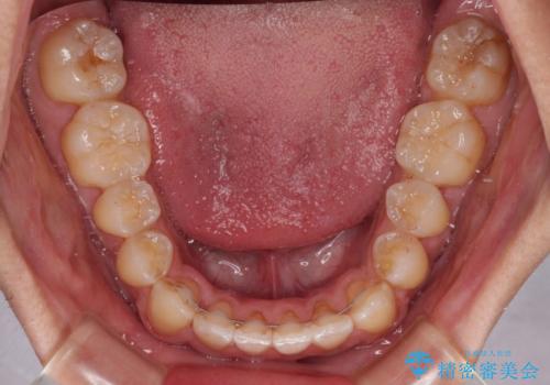 ワイヤー矯正を併用したインビザライン矯正治療の治療後