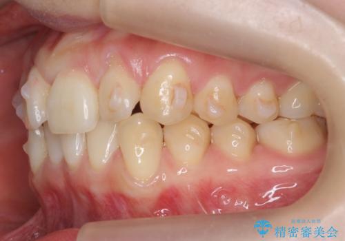 前歯がねじれている 奥歯を後ろに下げて歯を抜かずに並べましたの治療中