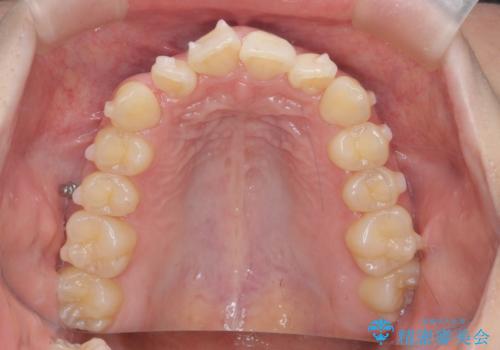 前歯がねじれている 奥歯を後ろに下げて歯を抜かずに並べましたの治療中