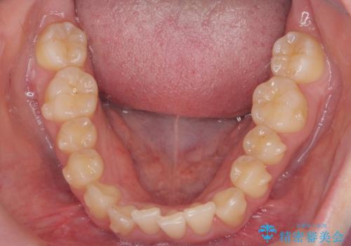 前歯がねじれている　奥歯を後ろに下げて歯を抜かずに並べましたの治療中