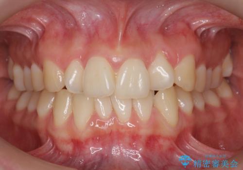 前歯がねじれている 奥歯を後ろに下げて歯を抜かずに並べましたの治療前