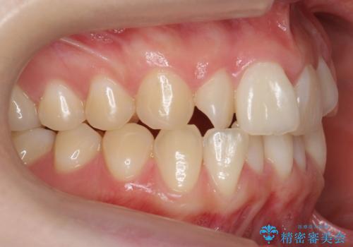 前歯がねじれている 奥歯を後ろに下げて歯を抜かずに並べましたの治療前