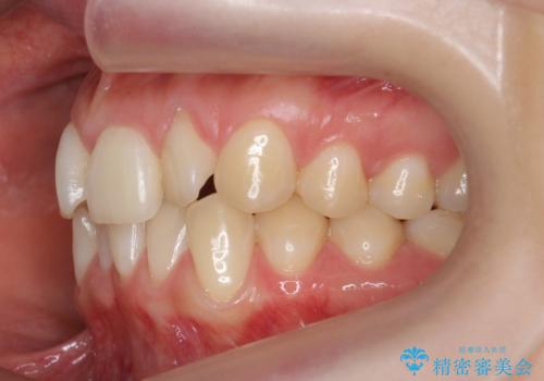 前歯がねじれている 奥歯を後ろに下げて歯を抜かずに並べましたの治療前