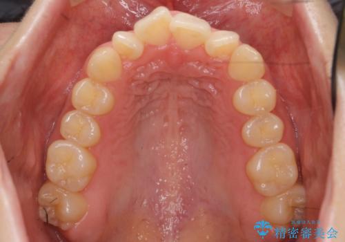 前歯がねじれている 奥歯を後ろに下げて歯を抜かずに並べましたの治療前