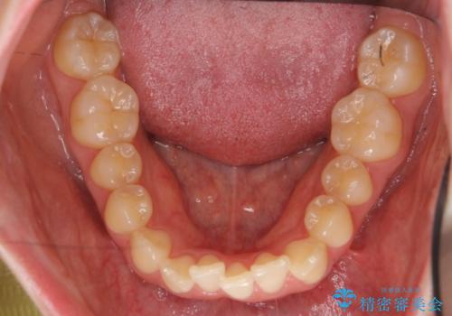 前歯がねじれている　奥歯を後ろに下げて歯を抜かずに並べましたの治療前