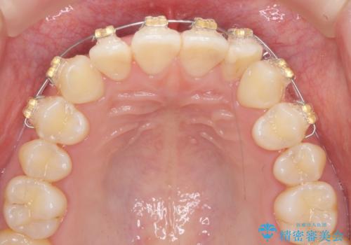 ワイヤー部分矯正治療を併用したマウスピース矯正治療の治療中