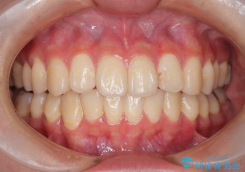 インビザラインによる矯正治療(非抜歯)　前歯の捻れとガタつきの改善の治療後