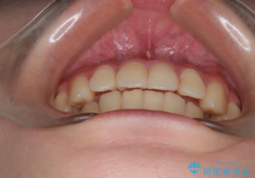 インビザラインによる矯正治療(非抜歯) 前歯の捻れとガタつきの改善の治療後