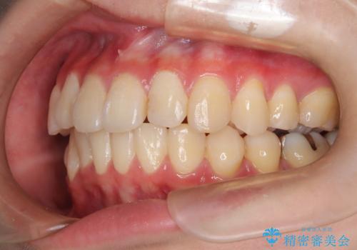 インビザラインによる矯正治療(非抜歯) 前歯の捻れとガタつきの改善の治療後