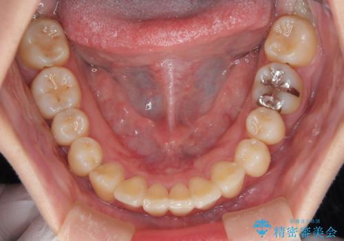 インビザラインによる矯正治療(非抜歯) 前歯の捻れとガタつきの改善の治療後