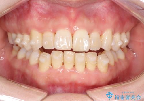 インビザラインによる矯正治療(非抜歯) 上下前歯の開き(開咬)と上下のガタつき(叢生)の改善の治療中