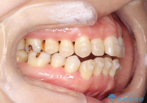 インビザラインによる矯正治療(非抜歯)　上下前歯の開き(開咬)と上下のガタつき(叢生)の改善の治療中