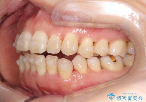 インビザラインによる矯正治療(非抜歯) 上下前歯の開き(開咬)と上下のガタつき(叢生)の改善の治療中
