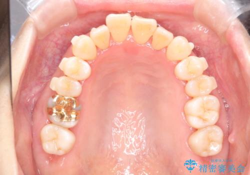 インビザラインによる矯正治療(非抜歯)　上下前歯の開き(開咬)と上下のガタつき(叢生)の改善の治療中