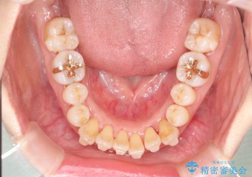 インビザラインによる矯正治療(非抜歯) 上下前歯の開き(開咬)と上下のガタつき(叢生)の改善の治療中