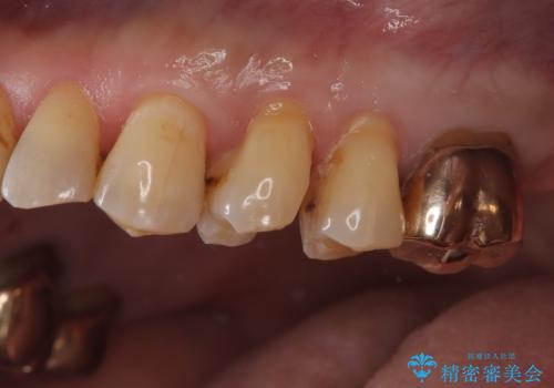 【ゴールドインレー PGA】フロスをしたら銀歯が取れたの治療前