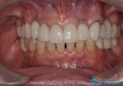 【オールセラミッククラウン・ファイバーコア】被せ物が揺れているの治療前