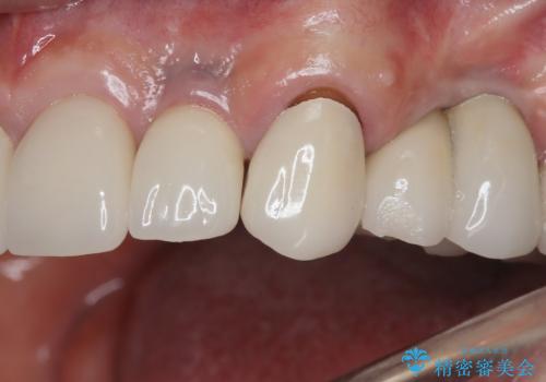 【オールセラミッククラウン・ファイバーコア】被せ物が揺れているの症例 治療前