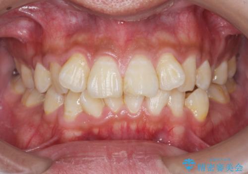 遠心移動を伴うマウスピース非抜歯矯正治療の症例 治療前