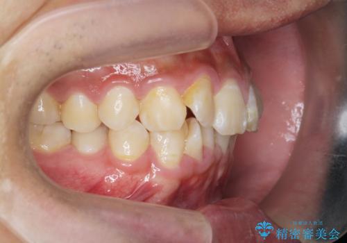 遠心移動を伴うマウスピース非抜歯矯正治療の治療前