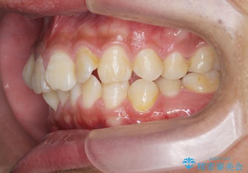 遠心移動を伴うマウスピース非抜歯矯正治療の治療前