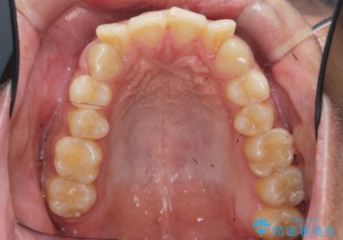 遠心移動を伴うマウスピース非抜歯矯正治療の治療前