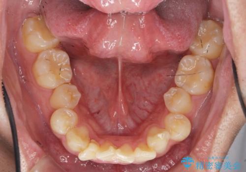 遠心移動を伴うマウスピース非抜歯矯正治療の治療前