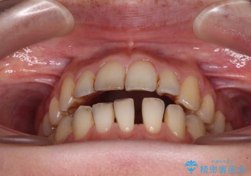 開咬と歯の欠損 ワイヤー装置を併用したインビザライン矯正治療の治療中