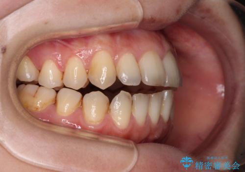 開咬と歯の欠損 ワイヤー装置を併用したインビザライン矯正治療の治療中