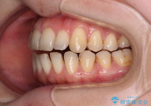 開咬と歯の欠損 ワイヤー装置を併用したインビザライン矯正治療の治療中