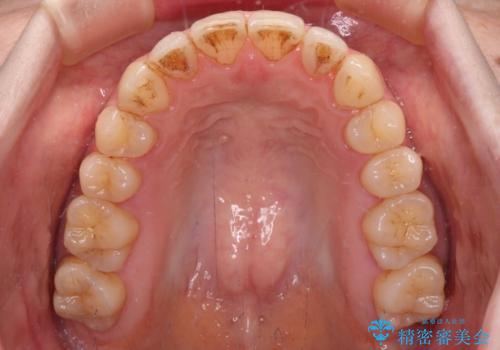 開咬と歯の欠損 ワイヤー装置を併用したインビザライン矯正治療の治療中