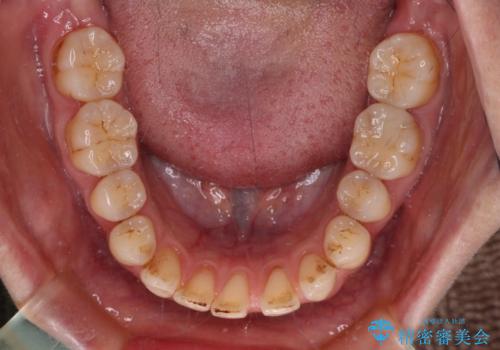 開咬と歯の欠損　ワイヤー装置を併用したインビザライン矯正治療の治療中