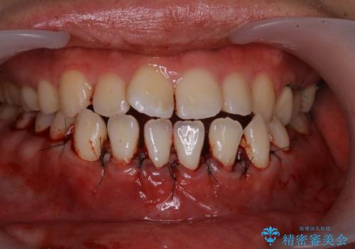 歯茎が薄い方へのインビザライン治療、歯肉退縮予防の治療中