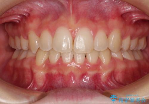 ワイヤー装置の抜歯矯正で横顔のシルエットをすっきりとの症例 治療後