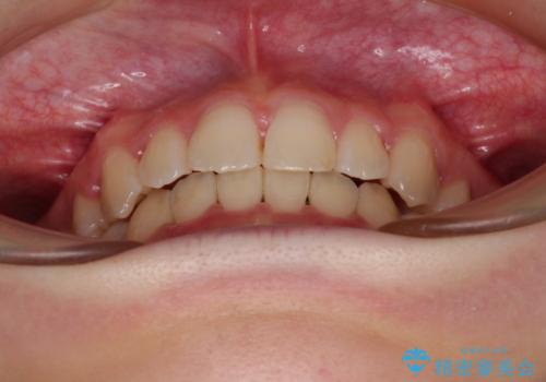 ワイヤー装置の抜歯矯正で横顔のシルエットをすっきりとの治療後